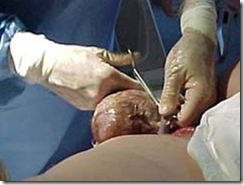 Clamp and Cut Nuchal Cord